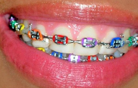 braces