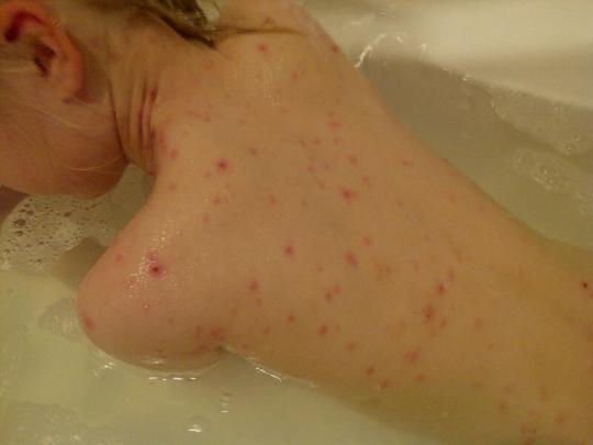 chickenpox