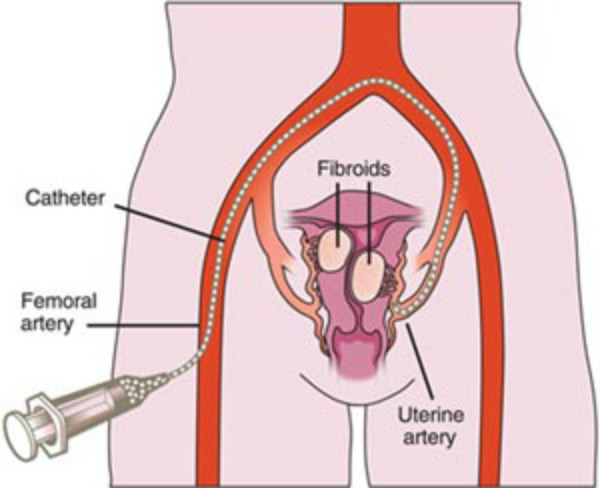 fibroid2